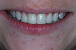 Patient’s mouth after recontouring teeth with plastic fillings