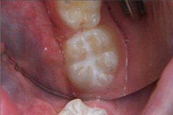 Patient's tooth after getting sealant