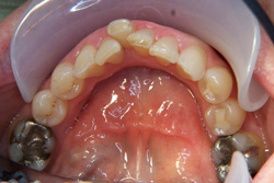 Patient's teeth before having Invisalign orthodontics