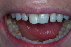 Patient's mouth before recontouring teeth with plastic fillings