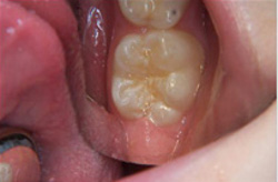 Patient's tooth before getting sealant