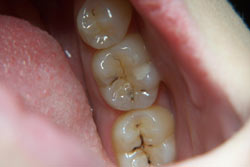 Patient's teeth before getting plastic fillings