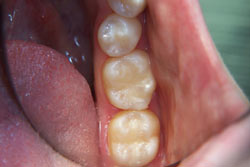 Patient's teeth after getting plastic fillings