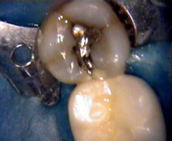 Intraoral image showing a yellow area indicating early decay