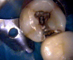 Intraoral image showing decay underneath the old filling