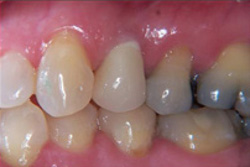 Implant restored with zirconium crown