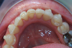 Patient's teeth after Invisalign expanded the arch to fit the teeth