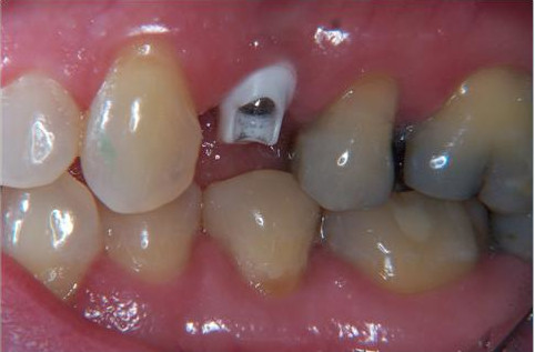 Implant (not visible) with white zirconium abutment Implant (not visible) with white zirconium abutment