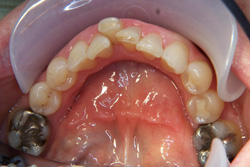 Patient's teeth before having Invisalign orthodontics Patient's teeth before having Invisalign orthodontics