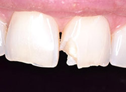 Before: Patient's mouth with chipped tooth