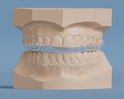 Patient wearing a nightguard used to alleviate jaw stiffness and headaches caused by grinding the teeth