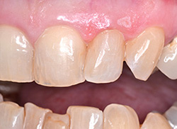 After: Patient's mouth with old plastic fillings removed and replaced 